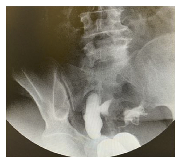 What is a Hysterosalpingogram?